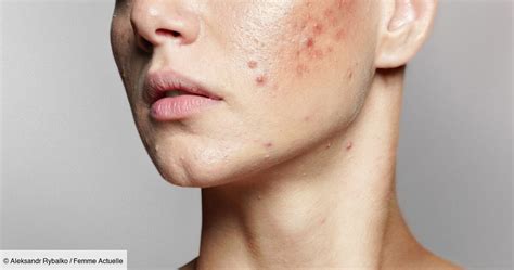 Acné : ce détail important à vérifier sur vos produits de soins pour ne pas la favoriser, selon un dermatologue