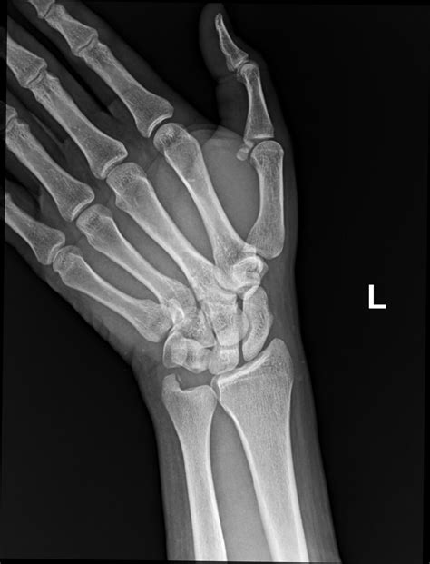 Radiopaedia case Ulnar styloid process avulsion fracture id: 63331 ...