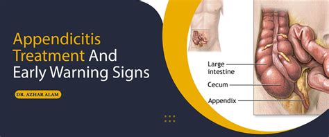 Appendicitis Treatment And Early Warning Signs