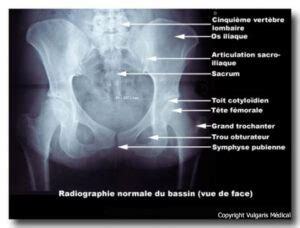 Bassin (radiographie de face) – Vulgaris-medical