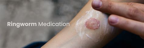 Ringworm Medications: Best Antifungal Treatments for Fast Relief