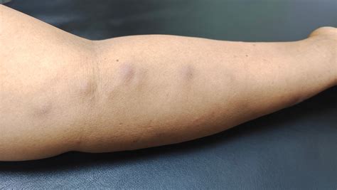 Infections fongiques: ce que vous ignorez au sujet des mycoses