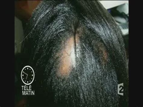 La calvitie de la femme noire