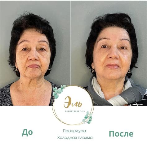 Холодная Плазма Алматы