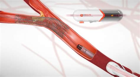 Tampa Carotid Artery Surgery Center | Vascular Surgery in Tampa