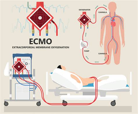 Learn About 2 Methods of ECMO : Reader Questions