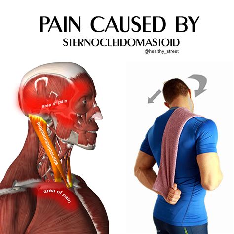 Sternocleidomastoid Muscle Swelling