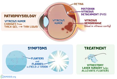 Posterior Vitreous Detachment Vision