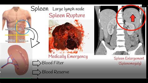 Ruptured Spleen Symptoms