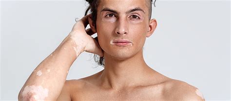 Vitiligo: causes and symptoms – Dr. Matteo Bordignon