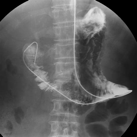 Afferent Loop Syndrome Radiology Notes Small And Large Bowel Volvulus: