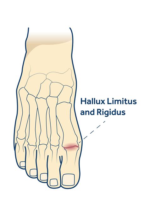 Hallux Limitus and Rigidus | Erko Podiatry | Podiatrists Sydney Inner West