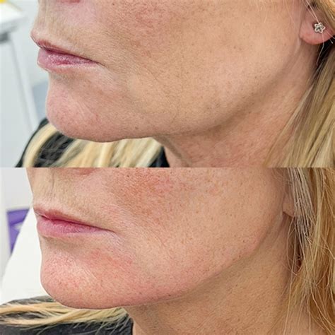 Filler Dissolving - Rejuvenate Clinics