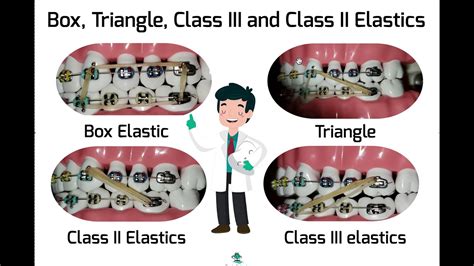 Triangle, Box, Class II and Class IIII Elastics