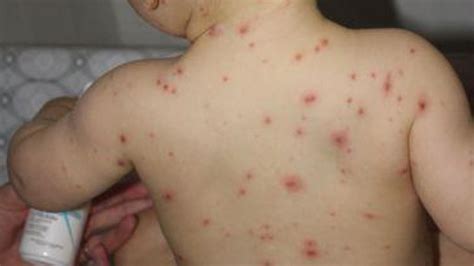 Varicelle à lécole quand retourner en classe ? - Mutig