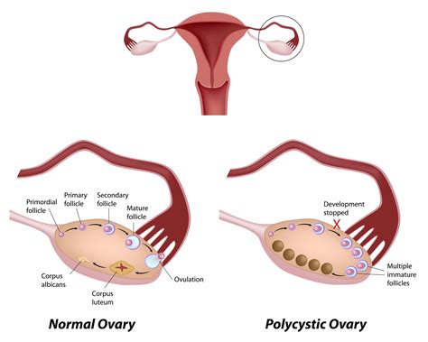 Controlling PCOS, Polycystic Ovarian Syndrome - AIM Women’s Wellness Center