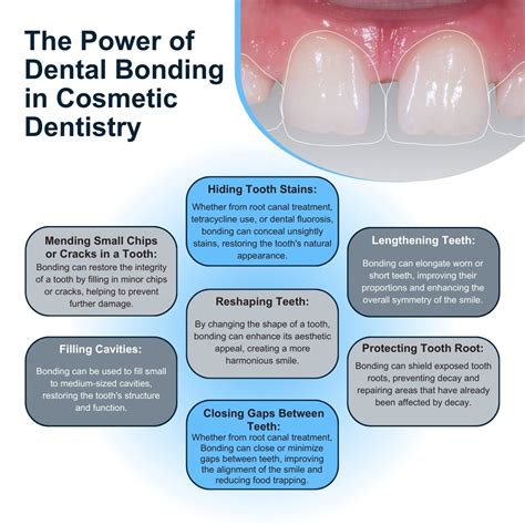 Dental Bonding in Astoria and Bayside, Queens, NY