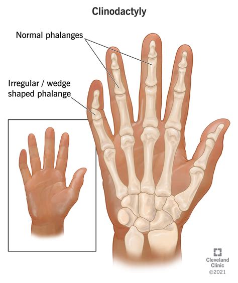 Trigger Finger Symptoms And Causes Mayo Clinic | atelier-yuwa.ciao.jp
