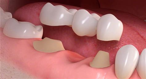 Dental Bridge To Replace 2 Missing Teeth at Christopher Lord blog