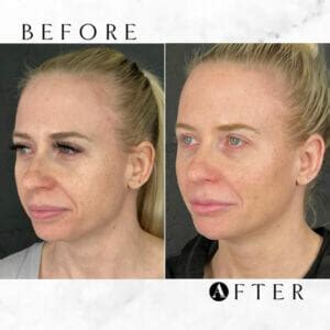 Filler migration and dissolving fillers: Understanding and managing the ...