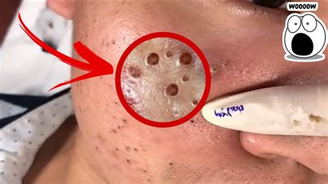 Blackheads Removal Compilation and Very Satisfying Satisfying Pimple pop #blackheads #pimplepop