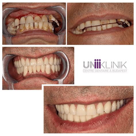 Solution semi-fixe : prothèse sur barre de rétention - UNIKLINIK ...