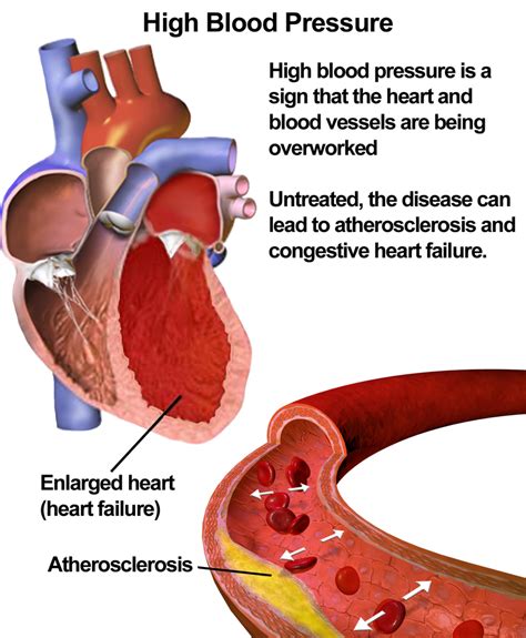 hypertension | Difference Between | hypertension