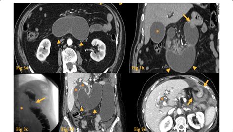 Afferent Loop Syndrome. Abdominal CT (a, b) of a patient who had ...