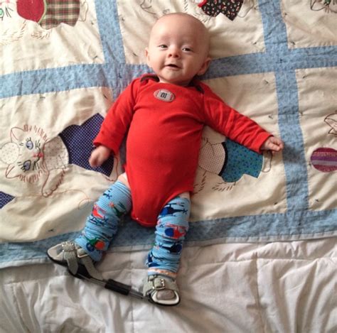 Must-Haves for a Clubfoot Little One - Kendall Rayburn | Club foot baby ...