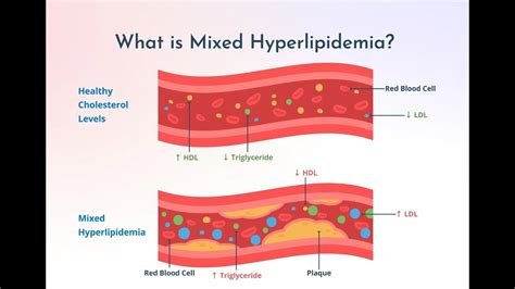 Mixed dyslipidemia Or mixed hyperlipidemia or familial combined hyperlipidemia ; Definition, Causes
