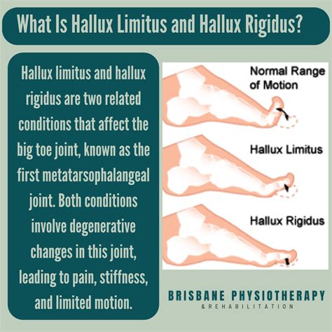 Hallux Limitus & Hallux Rigidus - Causes, Symptoms, Diagnosis ...