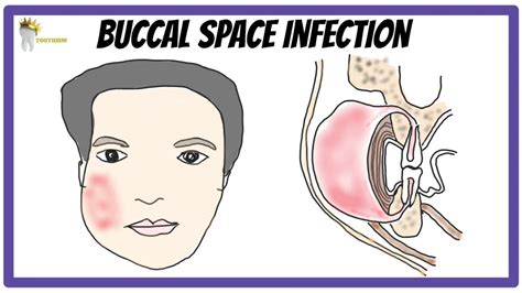 BUCCAL SPACE INFECTION | Boundaries, Clinical features, Management ...