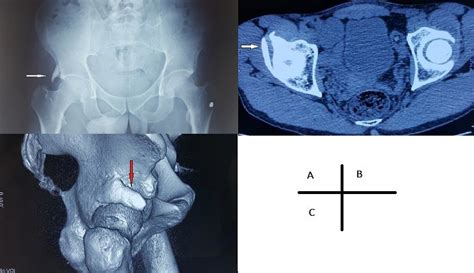 A) radiographie standard du bassin face montrant une protubérance ...