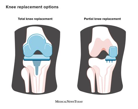 Total Knee Replacement: What You Need to Know