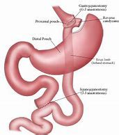 Articles by Dr. Baker - JEFFREY BAKER, MD BARIATRIC SURGEON