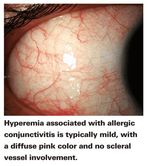 Code Red: The Key Features of Hyperemia