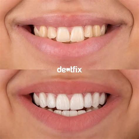 Turkey Teeth: che cos'è e puoi fidarti dei dentisti in Turchia?