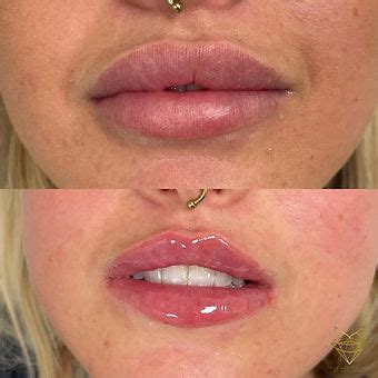 FILLER DISSOLVING | Fox Aesthetics