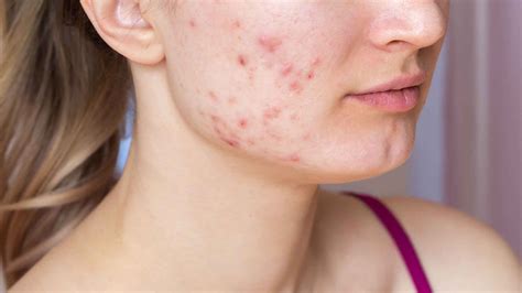 Acné : comment éviter les cicatrices