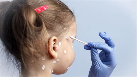 Varicelle : comment traiter l'infection