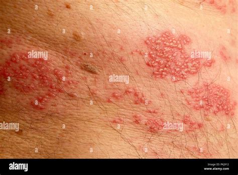 Infection de la peau cloques herpes Banque de photographies et d’images ...