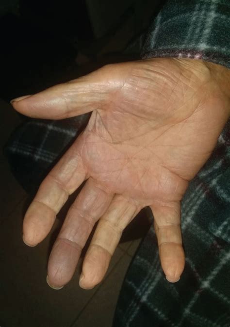 Blue Finger Syndrome in an Elderly Patient