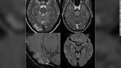 Elle souffre de maux de tête, on découvre des larves de ver solitaire ...