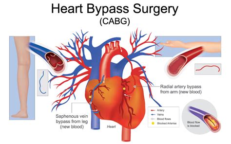 Oxygen Level After Bypass Surgery at Rebecca Hart blog