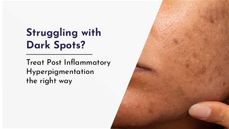 Post Inflammatory Hyperpigmentation Treatment for Clear Skin