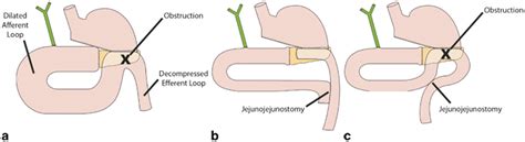 Afferent Loop Syndrome | Abdominal Key