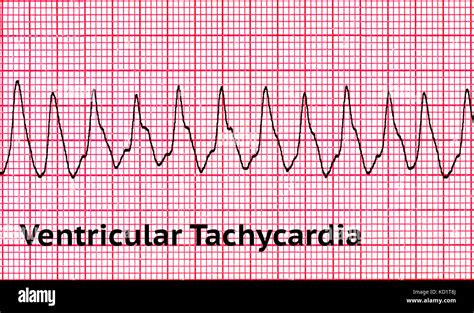 Ventricular tachycardia (VT Stock Photo: 162924850 - Alamy
