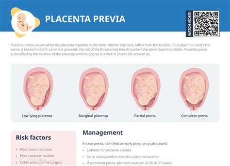 Placenta Previa Nhs Guidelines at Evie Rounsevell blog