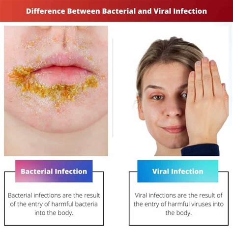 Infection bactérienne vs virale : différence et comparaison