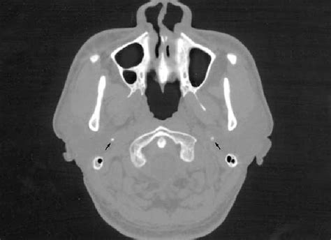 Case 1: Non-contrast CT scan of neck reveals elongation of the ...